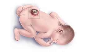 Spina bifida
